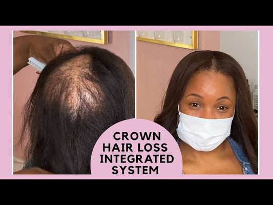 Crown Hair Loss Transformation – The Best Hair Extensions & Solutions in Gwinnett County