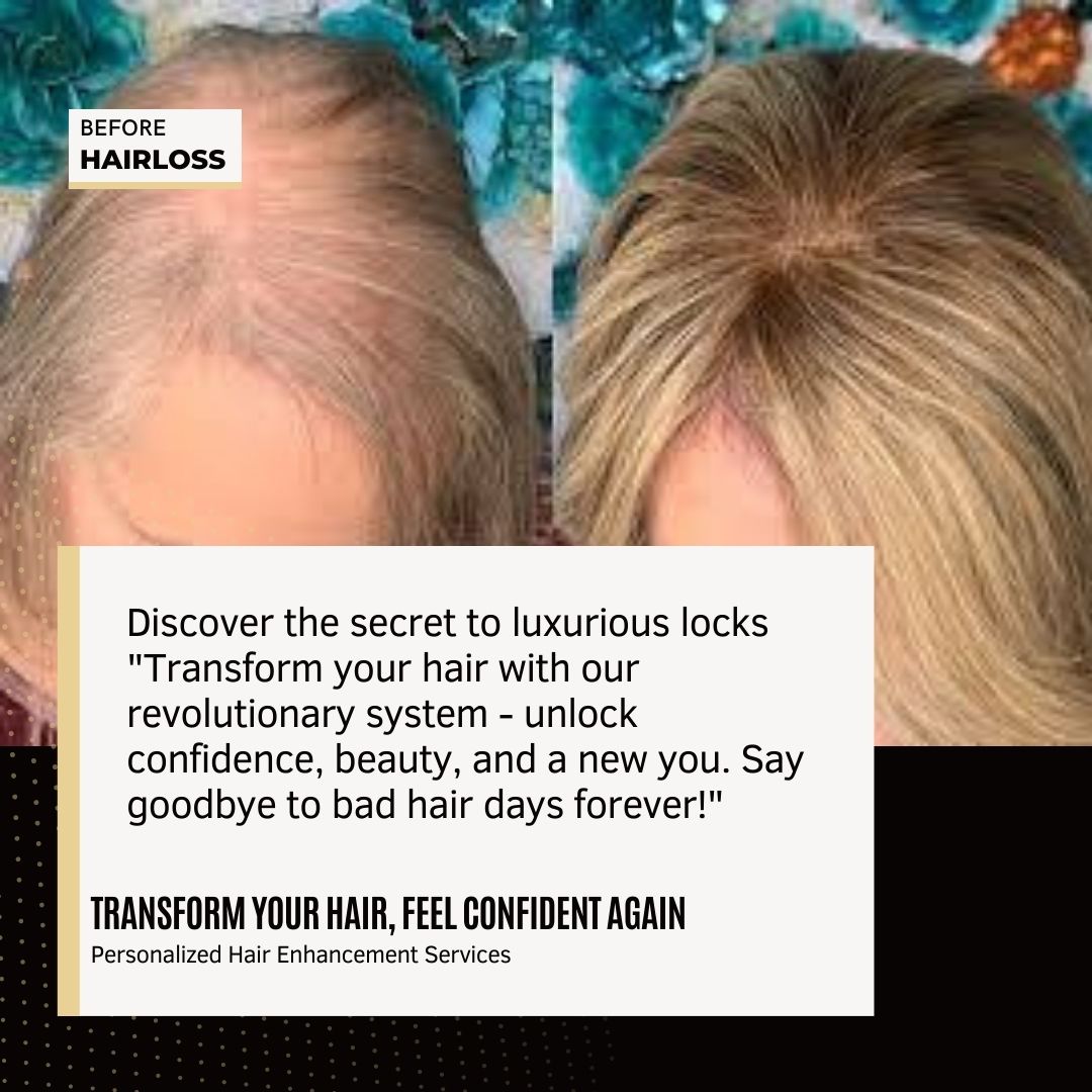 Insurance-Compatible Cranial Prosthesis | Use HCPCS Code S8095 for easy billing and reimbursement. Pair with the appropriate diagnosis code to ensure seamless coverage for hair loss due to medical conditions.

