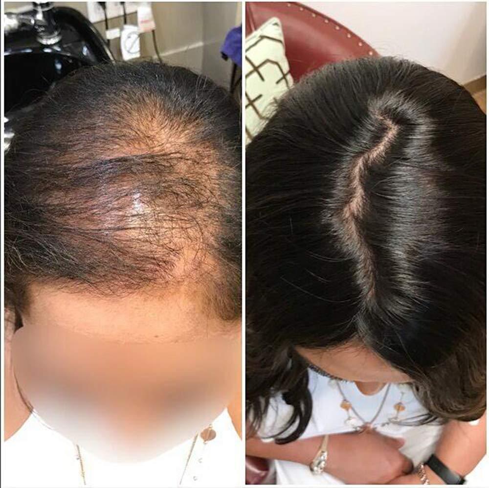 Hair Loss & Hair Replacement Solutions | Get A Private 1-on-1 Consultation