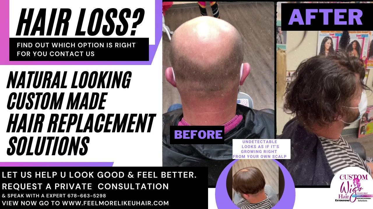 Hair Loss & Hair Replacement Solutions | Get A Private 1-on-1 Consultation
