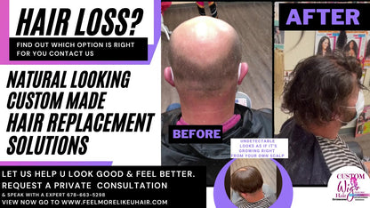 Hair Loss & Hair Replacement Solutions | Get A Private 1-on-1 Consultation
