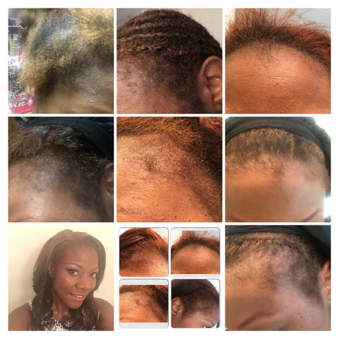 MY EDGES ARE BACK. No More Hair Loss Here's What's Working| Caring For Your Scalp Has Never Been This Easy